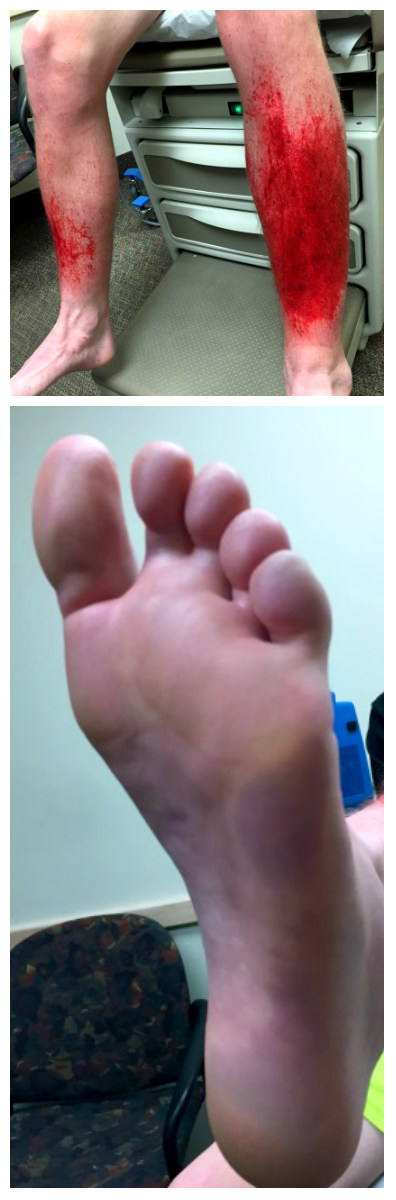 A close-up look at the effect of frostbite and shin abrasions caused by snow